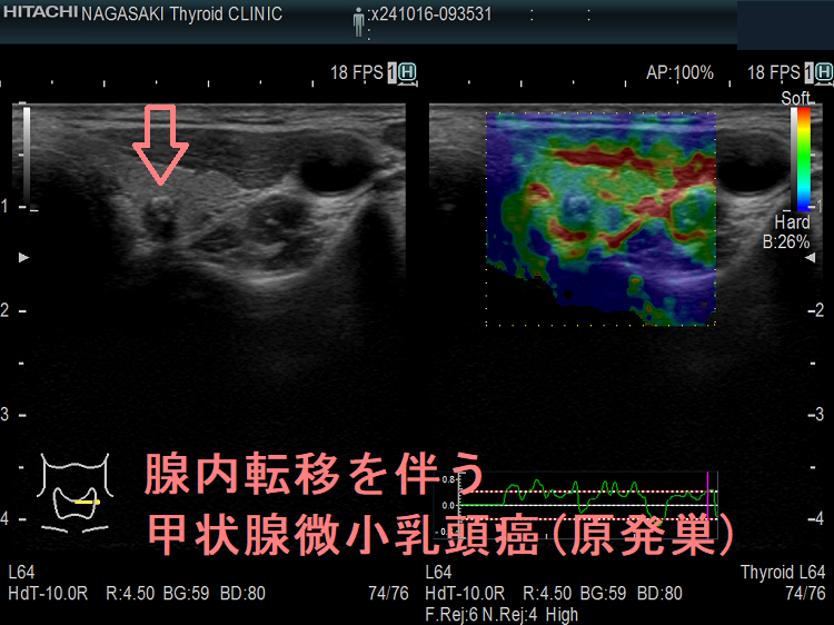 腺内転移を伴う甲状腺微小乳頭癌(原発巣)エラストグラフィー 腺内転移を伴う甲状腺微小乳頭癌(原発巣)エラストグラフィー