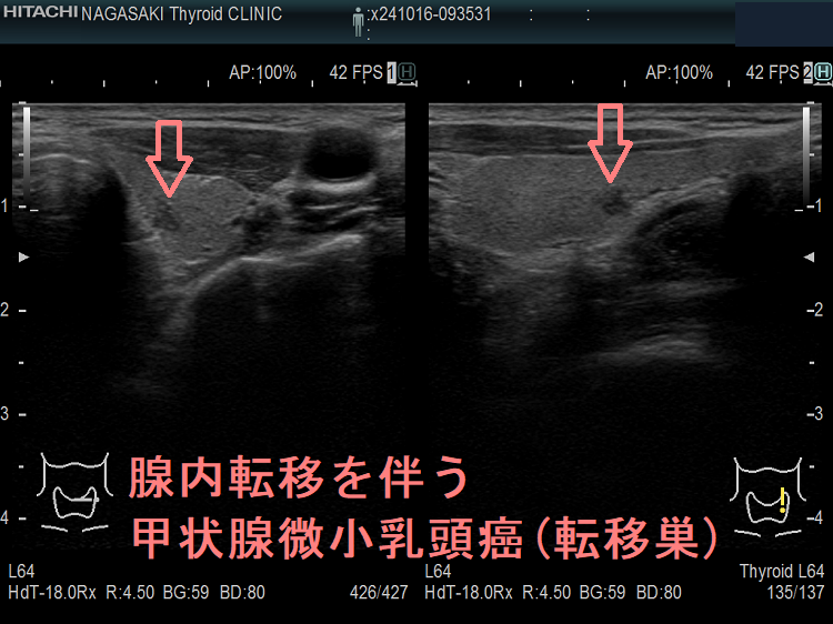 腺内転移を伴う甲状腺微小乳頭癌(転移巣) 超音波(エコー)画像 腺内転移を伴う甲状腺微小乳頭癌(転移巣) 超音波(エコー)画像