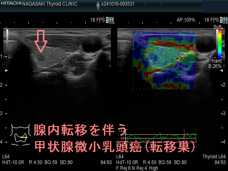 腺内転移を伴う甲状腺微小乳頭癌(転移巣) エラストグラフィー 腺内転移を伴う甲状腺微小乳頭癌(転移巣) エラストグラフィー
