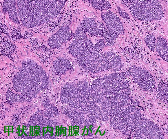 甲状腺内胸腺がん 組織像 甲状腺内胸腺がん 組織像