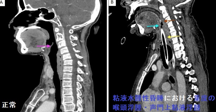 粘液水腫性昏睡における重度の喉頭浮腫・声門上粘液浮腫 粘液水腫性昏睡における重度の喉頭浮腫・声門上粘液浮腫