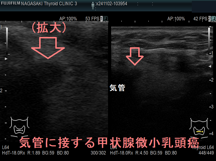 気管に接する甲状腺微小乳頭癌 気管に接する甲状腺微小乳頭癌