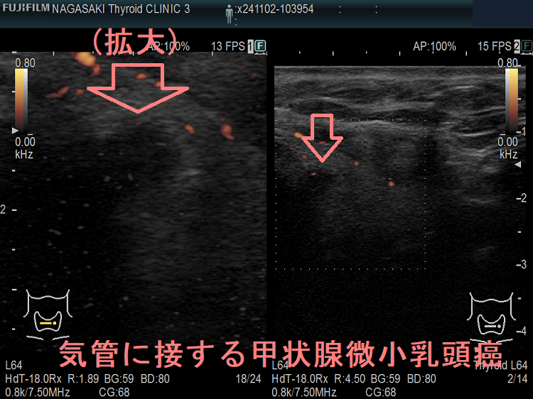 気管に接する甲状腺微小乳頭癌(拡大)ドプラーモード 気管に接する甲状腺微小乳頭癌(拡大)ドプラーモード