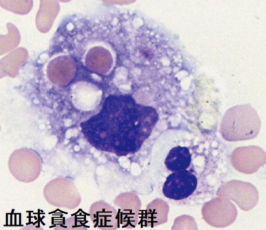 血球貪食症候群(HPS)の骨髄血塗抹May-Giemsa 染色標本 血球貪食症候群(HPS)の骨髄血塗抹May-Giemsa 染色標本