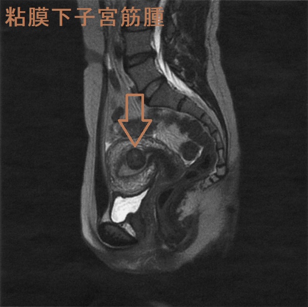 粘膜下子宮筋腫;骨盤部単純MRI T2 強調矢状断像 粘膜下子宮筋腫;骨盤部単純MRI T2 強調矢状断像