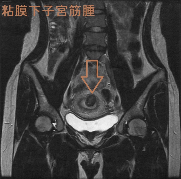 粘膜下子宮筋腫;骨盤部単純MRI T2 強調冠状断像 粘膜下子宮筋腫;骨盤部単純MRI T2 強調冠状断像