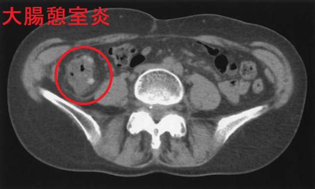 大腸憩室炎1 大腸憩室炎1