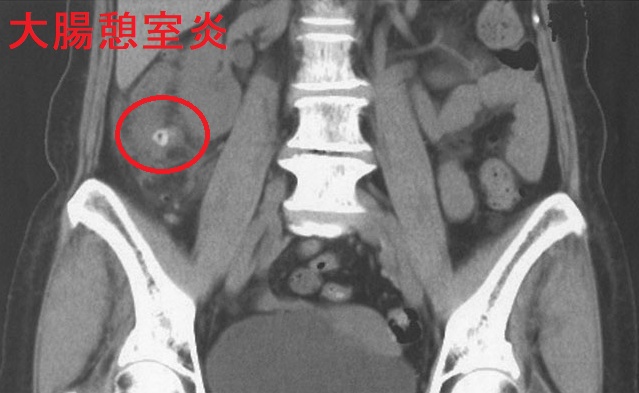 大腸憩室炎2 大腸憩室炎2