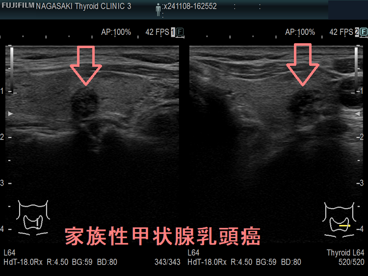 家族性甲状腺乳頭癌 超音波(エコー)画像 家族性甲状腺乳頭癌 超音波(エコー)画像