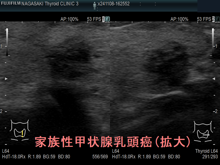 家族性甲状腺乳頭癌 超音波(エコー)画像 (拡大) 家族性甲状腺乳頭癌 超音波(エコー)画像 (拡大)