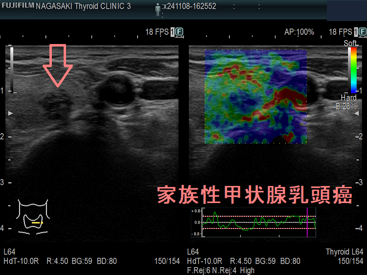家族性甲状腺乳頭癌 エラストグラフィー 家族性甲状腺乳頭癌 エラストグラフィー