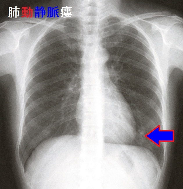 肺動静脈瘻 胸部エックス線写真 肺動静脈瘻 胸部エックス線写真