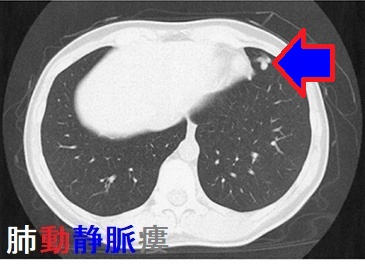 肺動静脈瘻 胸部単純CT写真 肺動静脈瘻 胸部単純CT写真