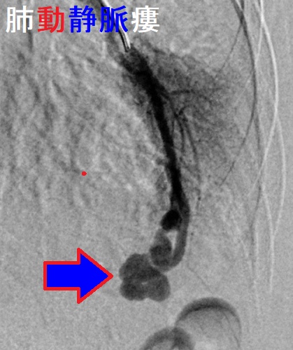 肺動静脈瘻 選択的肺動脈造影 肺動静脈瘻 選択的肺動脈造影