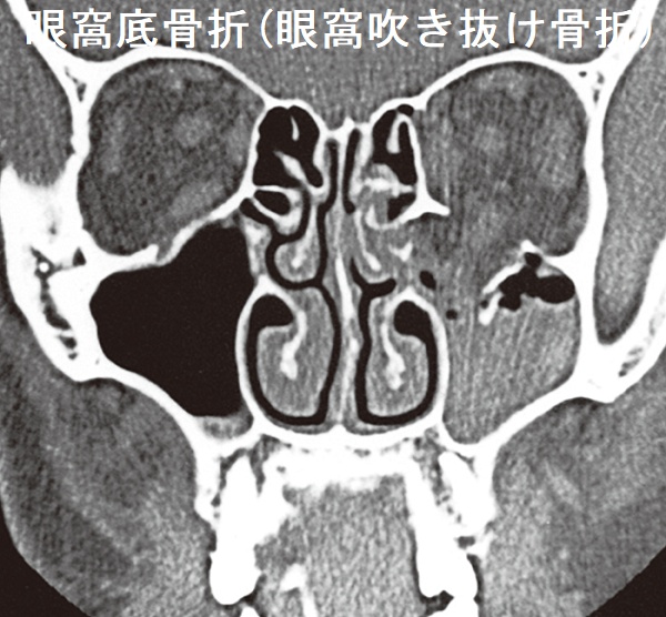 眼窩底骨折(眼窩吹き抜け骨折)CT写真 眼窩底骨折(眼窩吹き抜け骨折)CT写真
