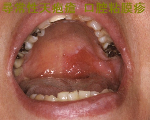 眼類天疱瘡