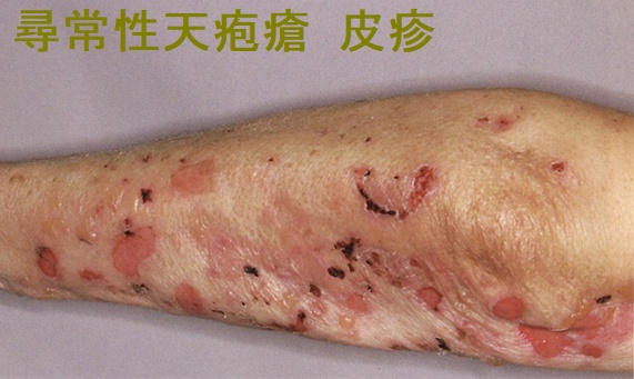 尋常性天疱瘡 皮疹 尋常性天疱瘡 皮疹
