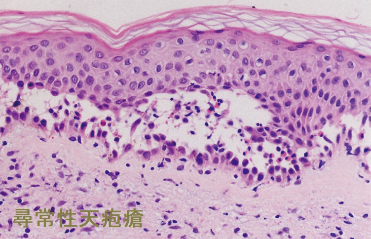 尋常性天疱瘡 皮膚生検 尋常性天疱瘡 皮膚生検