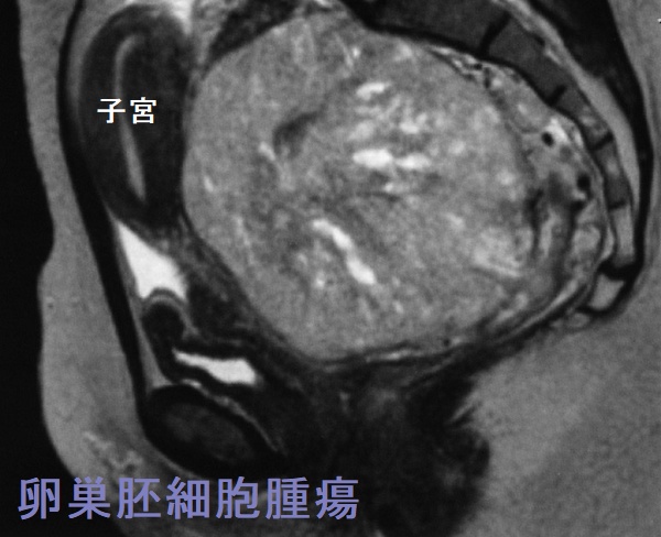 卵巣胚細胞腫瘍 骨盤部MRI T2 強調状断像 卵巣胚細胞腫瘍 骨盤部MRI T2 強調状断像