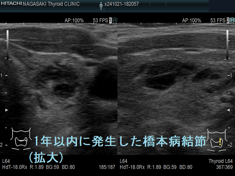 1年以内に発生した橋本病結節(拡大) 1年以内に発生した橋本病結節(拡大)