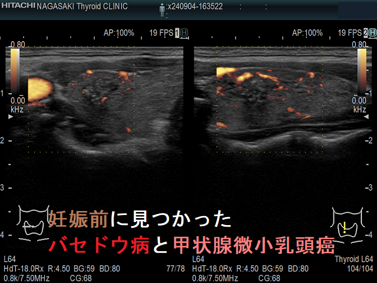 妊娠・計画妊娠と甲状腺機能亢進症/バセドウ病[橋本病 甲状腺超