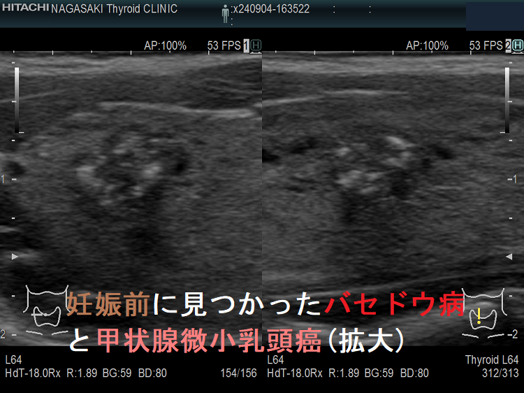 妊娠前に見つかったバセドウ病と甲状腺微小乳頭癌(拡大) 妊娠前に見つかったバセドウ病と甲状腺微小乳頭癌(拡大)