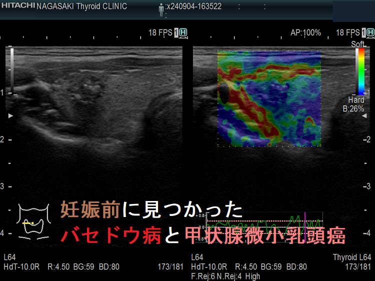妊娠前に見つかったバセドウ病と甲状腺微小乳頭癌 エラストグラフィー 妊娠前に見つかったバセドウ病と甲状腺微小乳頭癌 エラストグラフィー