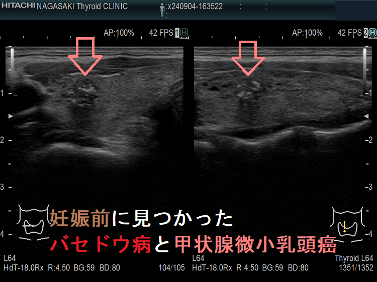 妊娠前に見つかったバセドウ病と甲状腺微小乳頭癌 妊娠前に見つかったバセドウ病と甲状腺微小乳頭癌