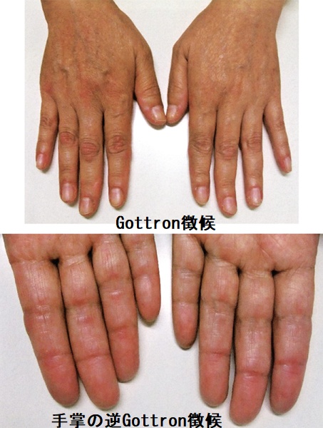 手掌の逆Gottron徴候 手掌の逆Gottron徴候