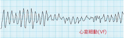 心室細動(Vf) 心室細動(Vf)
