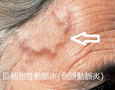 巨細胞性動脈炎(側頭動脈炎) 巨細胞性動脈炎(側頭動脈炎)