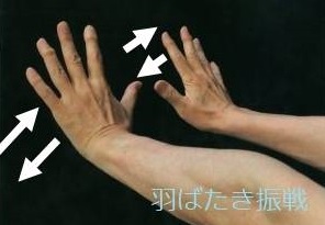 羽ばたき振戦 羽ばたき振戦