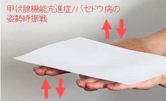 甲状腺機能亢進症 バセドウ病の姿勢時振戦 甲状腺機能亢進症 バセドウ病の姿勢時振戦