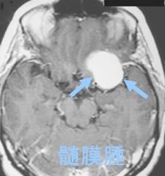 髄膜腫 髄膜腫