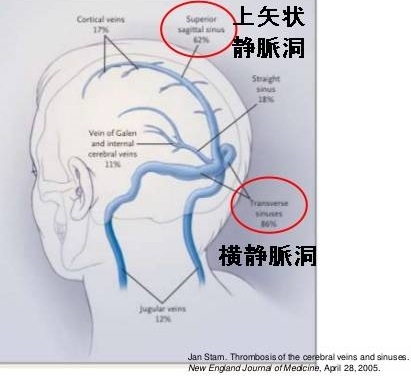 脳静脈洞血栓 脳静脈洞血栓