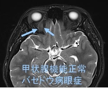 甲状腺機能正常バセドウ病眼症 MRI画像 甲状腺機能正常バセドウ病眼症 MRI画像