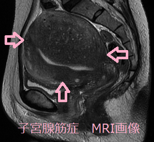 子宮腺筋症 MRI画像 子宮腺筋症 MRI画像