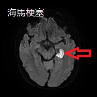 海馬梗塞 MRI画像 海馬梗塞 MRI画像