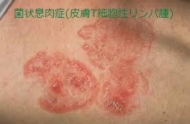 菌状息肉症(皮膚T細胞性リンパ腫) 菌状息肉症(皮膚T細胞性リンパ腫)