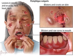 尋常性天疱瘡 尋常性天疱瘡