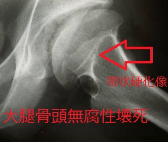 大腿骨頭無腐性壊死 単純X-p 大腿骨頭無腐性壊死 単純X-p