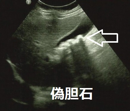 ceftriaxone(CTRX:ロセフィン)で偽胆石 ceftriaxone(CTRX:ロセフィン)で偽胆石