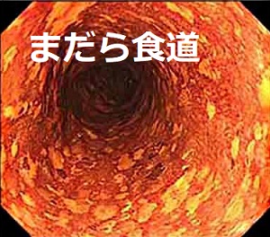 まだら食道 まだら食道