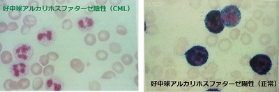 慢性骨髄性白血病(CML) 好中球アルカリホスファターゼ 慢性骨髄性白血病(CML) 好中球アルカリホスファターゼ