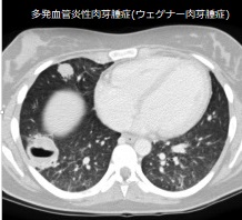 多発血管炎性肉芽腫症(ウェゲナー肉芽腫症)肺CT 多発血管炎性肉芽腫症(ウェゲナー肉芽腫症)肺CT