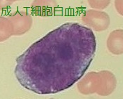 これも成人T細胞白血病(ATL)細胞 これも成人T細胞白血病(ATL)細胞