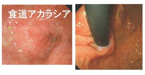 食道アカラシア 食道アカラシア