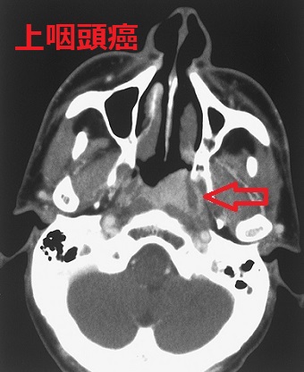 上咽頭がん 造影CT画像 上咽頭がん 造影CT画像