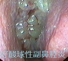 好酸球性副鼻腔炎 鼻茸 好酸球性副鼻腔炎 鼻茸