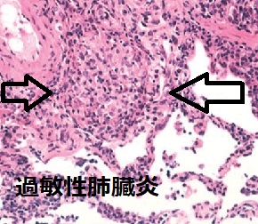 過敏性肺臓炎 TBLB(経気管支肺生検) 過敏性肺臓炎 TBLB(経気管支肺生検)